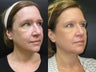 53 year old woman treated with Ulthera