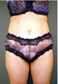 Tumescent Liposuction