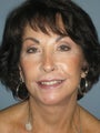 LiteLift™, Blepharoplasty, Platysmaplasty on 67-year-old Woman