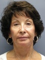 LiteLift™, Blepharoplasty, Platysmaplasty on 67-year-old Woman