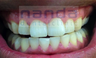 Teeth Whitening