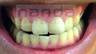 Teeth Whitening
