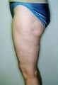 Female patient who underwent a butt lift