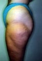 Female patient who underwent a butt lift