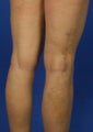 35 Year Old Female Treated For Varicose Veins