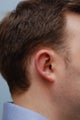 cosmetic ear surgery, otoplasty prominent ears
