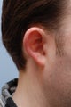 cosmetic ear surgery, otoplasty prominent ears