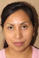 Facial remodeling with lower blepharoplasty and midface lift