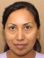 Facial remodeling with lower blepharoplasty and midface lift