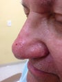 75 year old man with nasal veins treated with Ellman microneedle radio frequency