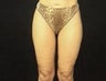 Thighplasty/Body Lift