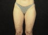 Thighplasty/Body Lift