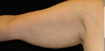 Upper Arm Lift