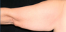 Upper Arm Lift