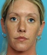 30 Year-Old Female Treated For Protruding Ears