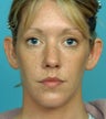 30 Year-Old Female Treated For Protruding Ears
