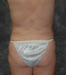 Vaser Liposuction