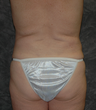 Vaser Liposuction
