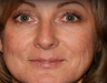 Laser Resurfacing