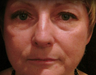 Laser Resurfacing