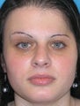 Foundation Rhinoplasty