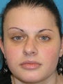 Foundation Rhinoplasty