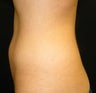 CoolSculpting