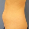 CoolSculpting