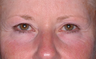 Ulthera