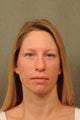 36 year old female treated for uneven facial pigmentation