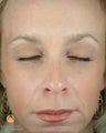 Female Patient Treated with BOTOX® Cosmetic