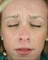 Female Patient Treated with BOTOX® Cosmetic