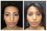 Rhinoplasty