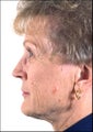 Rhinoplasty on Mature Adult