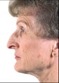 Rhinoplasty on Mature Adult