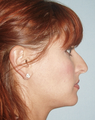 30 year old, cosmetic nasal deformity and difficulty breathing