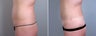 Mini Tummy Tuck
