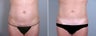 Mini Tummy Tuck