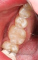 Replacement of Silver Amalgam Fillings with Tooth-Colored Composite Fillings