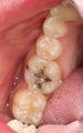Replacement of Silver Amalgam Fillings with Tooth-Colored Composite Fillings
