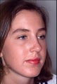 Rhinoplasty to correct multiple issues