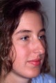 Rhinoplasty to correct multiple issues