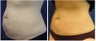 CoolSculpting Results