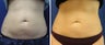 CoolSculpting Results