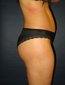 Butt Augmentation
