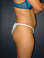Butt Augmentation