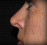 Rhinoplasty