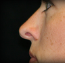 Rhinoplasty
