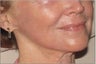 Co2 laser resurfacing