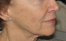Co2 laser resurfacing